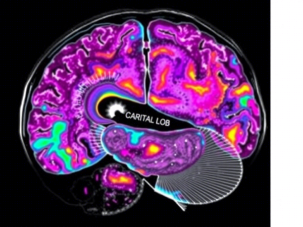 Brain PET Scan